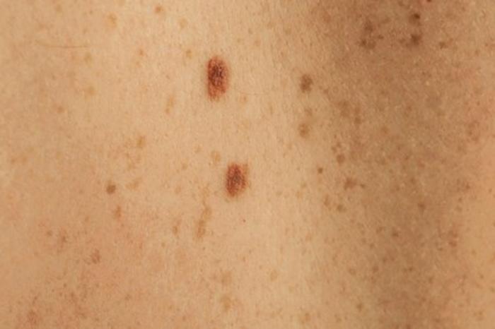 Nốt ruồi giữa các ngón tay có ý nghĩa gì đối với bạn? 314164101