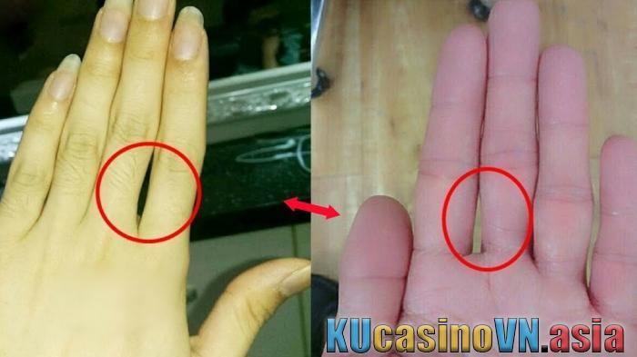 nốt ruồi giữa các ngón tay