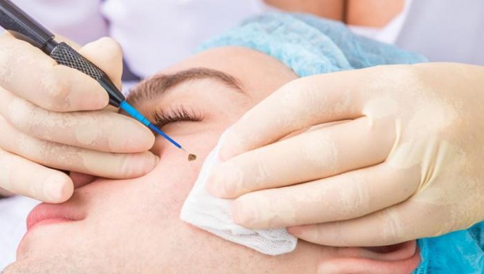 Trả lời câu hỏi có nên tẩy nốt ruồi không?