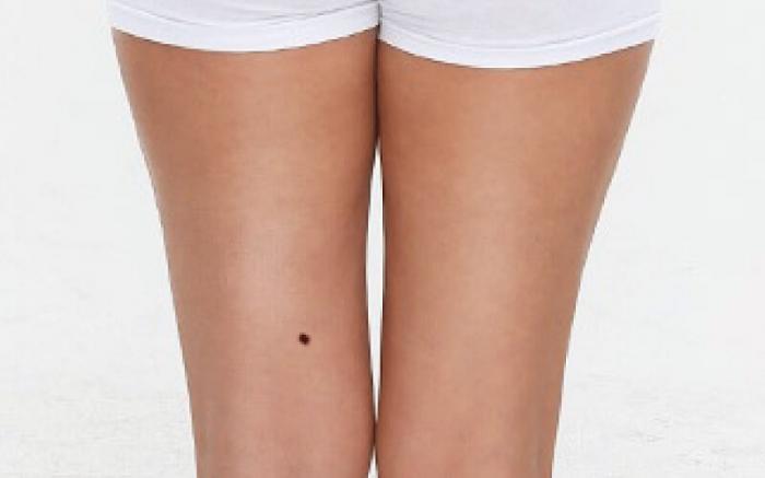 Khám phá: Nốt ruồi trên đùi trái báo hiệu điều gì?