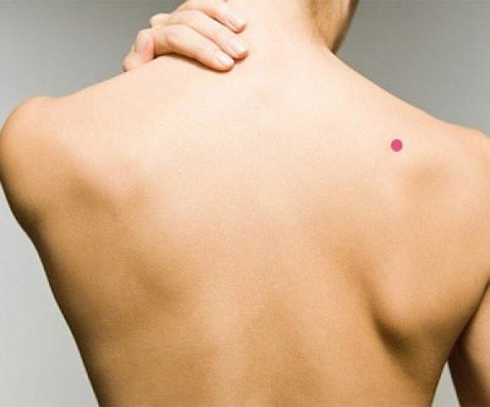 Nốt ruồi trên vai phải có ý nghĩa gì?