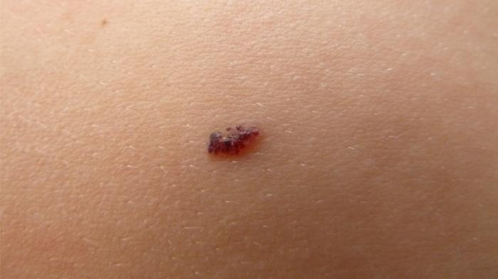 Nốt ruồi lồi - Nguyên nhân và Cảnh báo nguy hiểm 1547127544