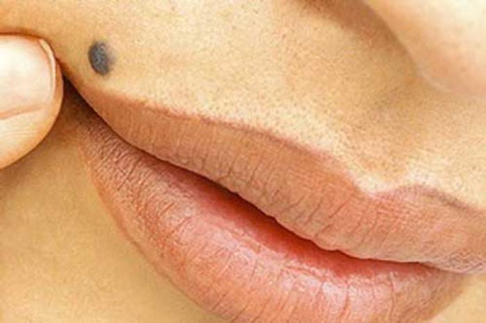 Nốt ruồi lồi - Nguyên nhân và Cảnh báo nguy hiểm 1547127544