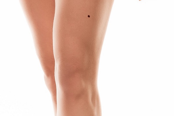 Nốt ruồi trên đùi phải có ý nghĩa gì?