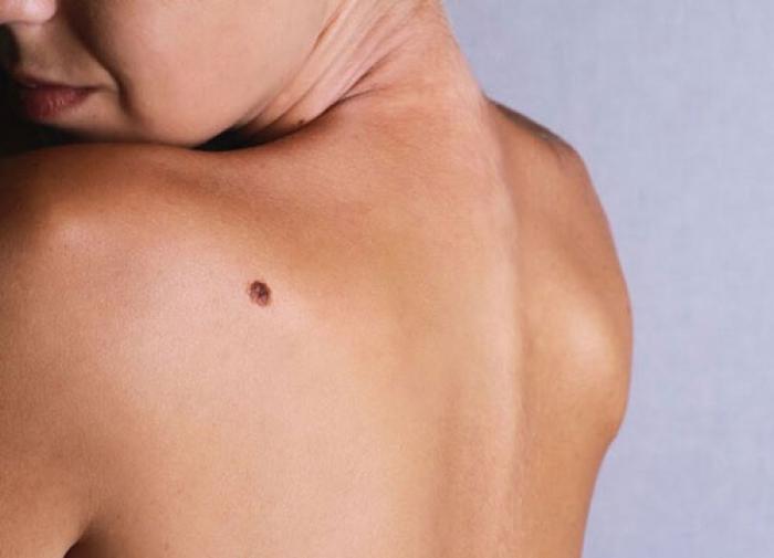 Giải mã ý nghĩa nốt ruồi ở vai trái