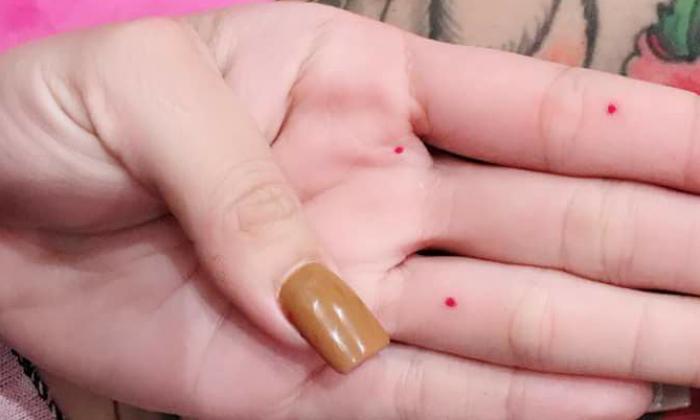 Nốt ruồi son là gì? Vị trí nào được coi là thuận lợi cho sự phát triển của nốt ruồi son?