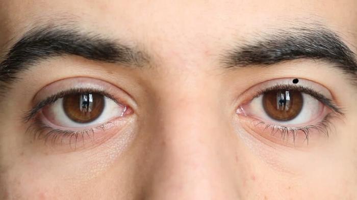 Nốt ruồi trên mắt phải có ý nghĩa gì?
