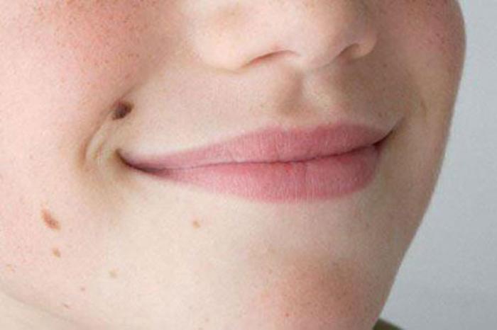 Nốt ruồi thịt - nhận diện tâm linh và ý nghĩa của nốt ruồi